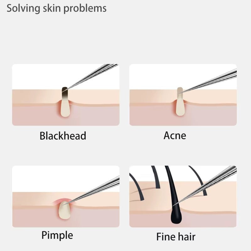 Stainless Steel Blackhead Remover Tool