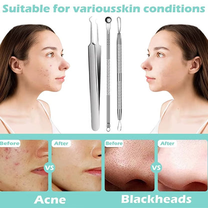 Stainless Steel Blackhead Remover Tool
